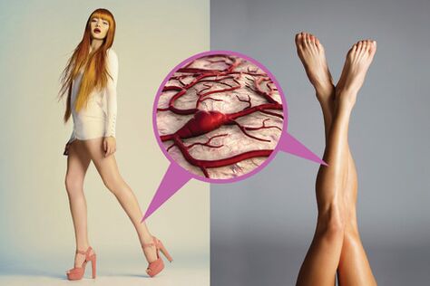 Varicose veins on their feet