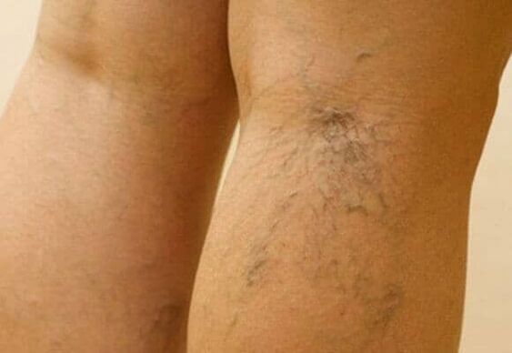 Varicose veins