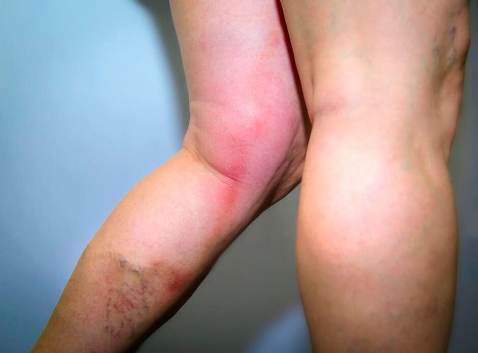 Consequences of varicose vein