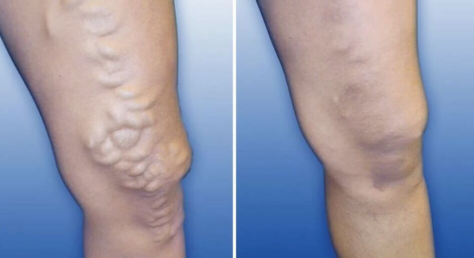 Degree of varicose veins