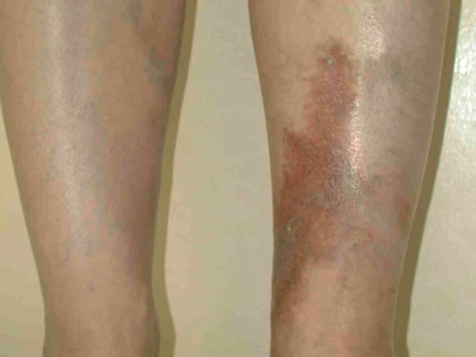 Varicose vein stages