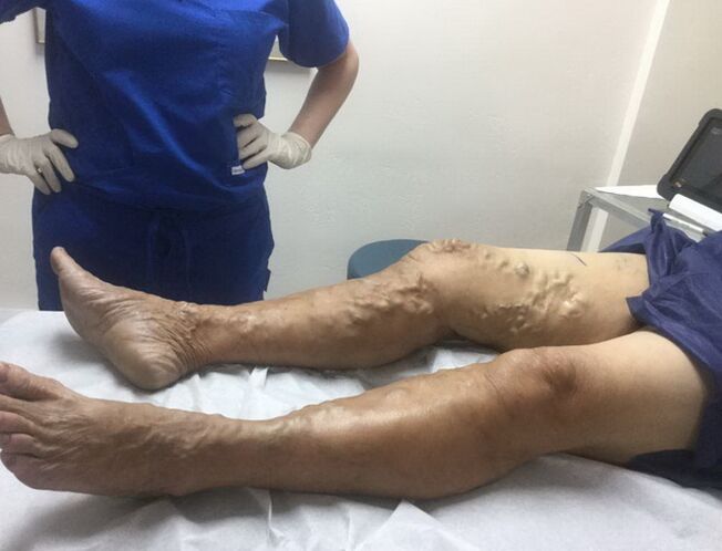 How to recognize the character of varicose veins