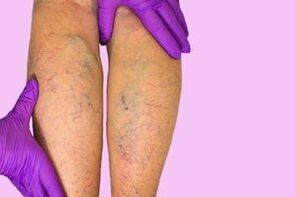 Varicose veins on the legs