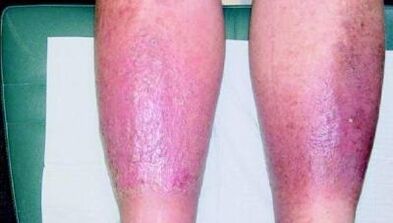 the third stage of varicose veins on the legs