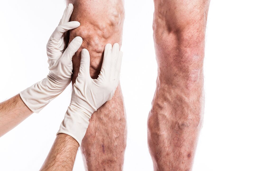 A phlebologist examines the legs of a patient with varicose veins