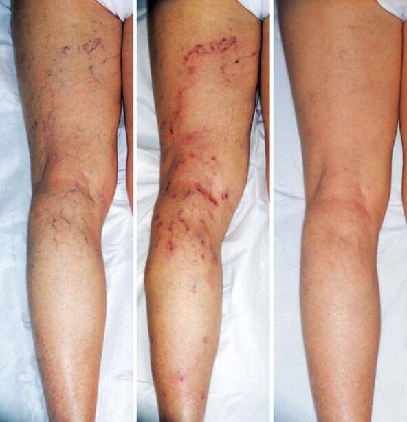stage of varicose veins of the lower extremities