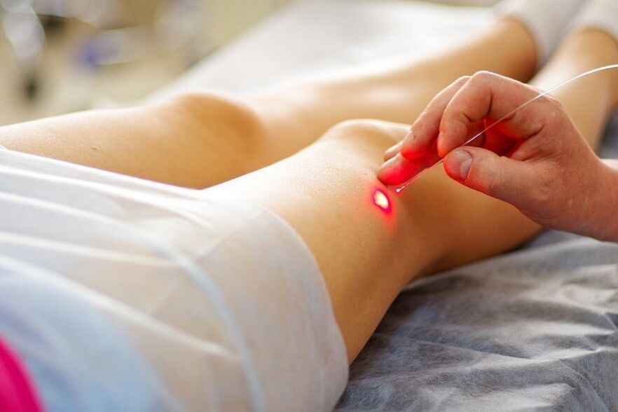 laser treatment of varicose veins