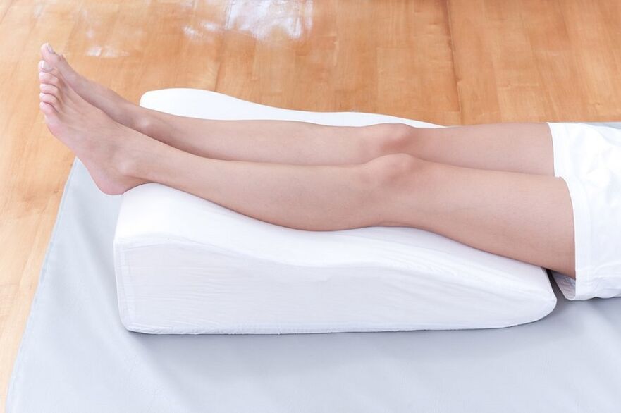 varicose veins on the legs