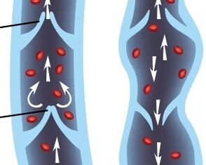 operation of the valve apparatus of the veins of the lower extremities