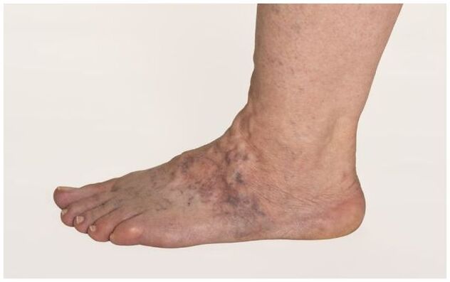 Varicose veins on the male leg, complicated by trophic ulcers