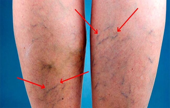 Protruding veins on the legs with varicose veins