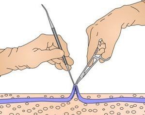 Miniphlebectomy - removal of the part of the vein affected by varicose veins