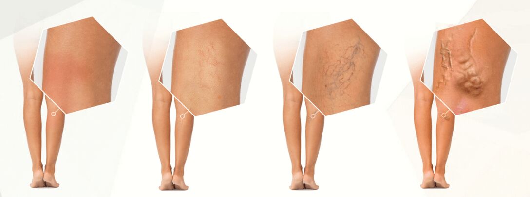 Degree of development of varicose veins of the lower extremities