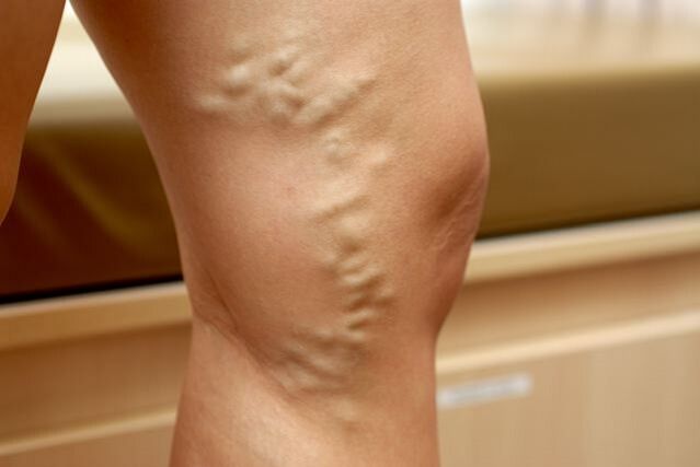 Protruding deformed vein on leg with varicose veins stage 3