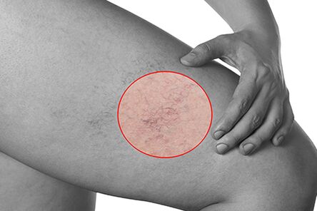 Telangiectasia in varicose veins of the lower extremities