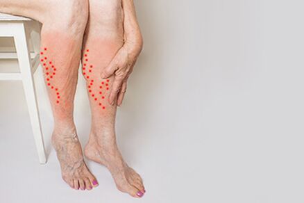 Tingling and heaviness in the legs - symptoms of varicose veins