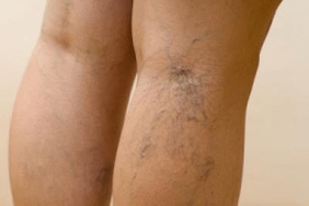 a photograph of varicose veins in the legs