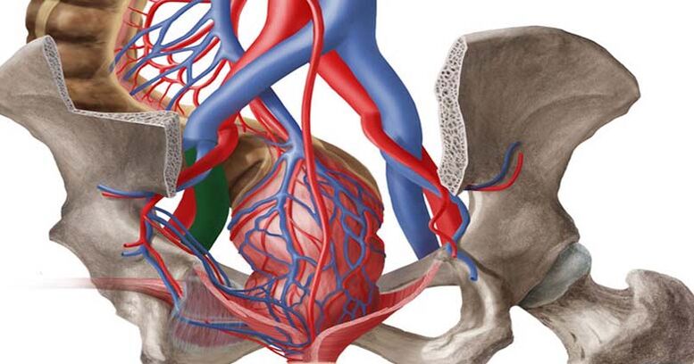 Dilated pelvic veins